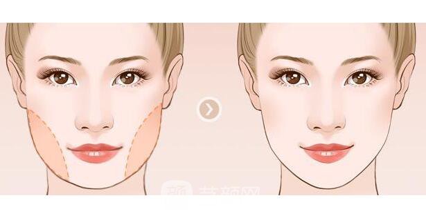 面部精细吸脂果好吗?面部精细吸脂果?