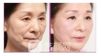 生物除皱价格多少?生物除皱价格影响因素~