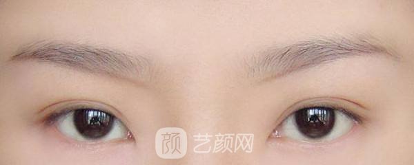 激光洗眉术后护理注意事项