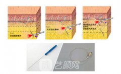 上海光纤溶脂多少钱？光纤溶脂多少钱和什么有关~