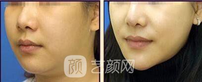 光纤溶脂瘦脸的副作用有哪些?