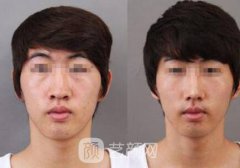 宽鼻缩窄术价格多少?宽鼻缩窄术价格影响因素~