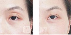自体脂肪丰眼窝多少钱?自体脂肪丰眼窝价格影响因素?