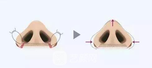 鼻骨缩小术价格多少?鼻骨缩小术价格影响因素?