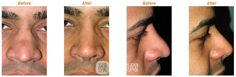 民族鼻整形术果