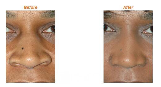 民族鼻整形术果