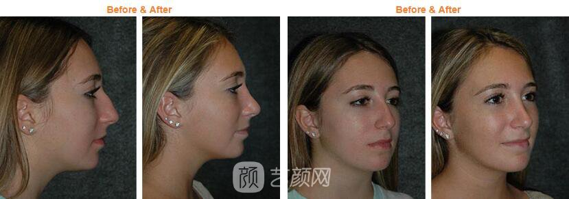 未成年做隆鼻手术以后需要注意什么