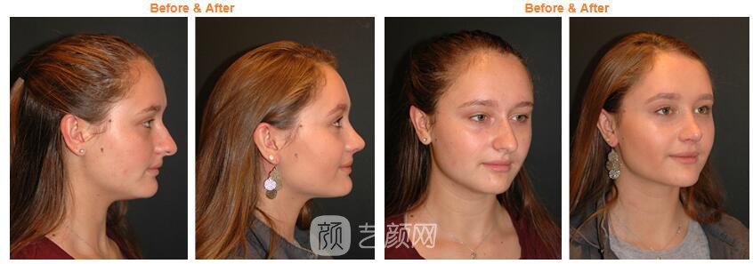 未成年做隆鼻手术以后需要注意什么