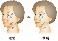 北京做内窥镜除皱一般多少钱？