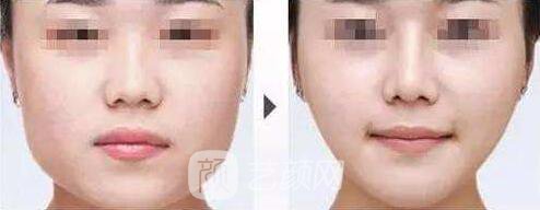 注射瘦脸前后果图