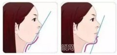 广州深覆颌矫正多少钱