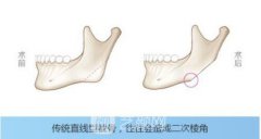 厦门磨下颌角价格多少?磨下颌角价格影响因素~
