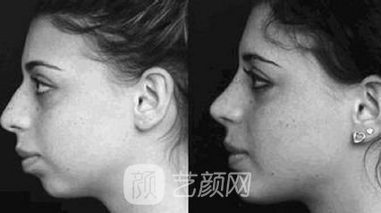 垫下巴手术前后的注意事项有哪些？