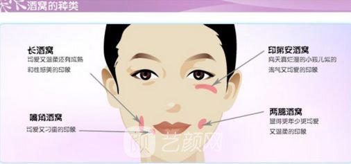 人造酒窝贵吗?需要多少钱?