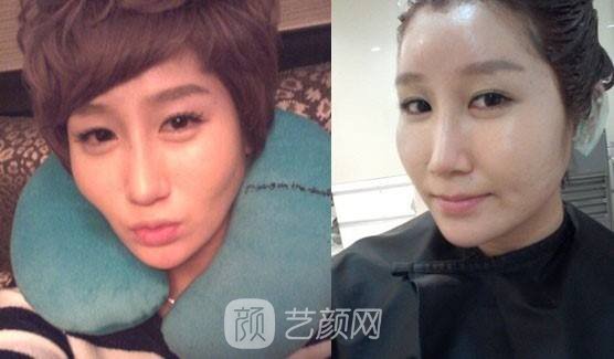 自体脂肪面部填充有哪些优势？果好嘛？