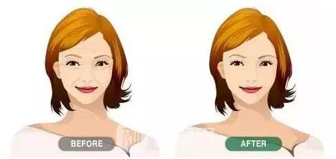 保妥-适生物除皱果图,保妥-适生物除皱果好吗?