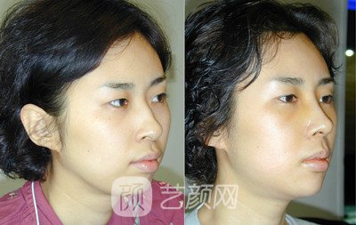 注射隆鼻果好吗?注射隆鼻果图~