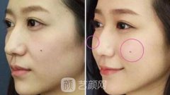 上海胶原蛋白注射丰苹果肌多少钱?