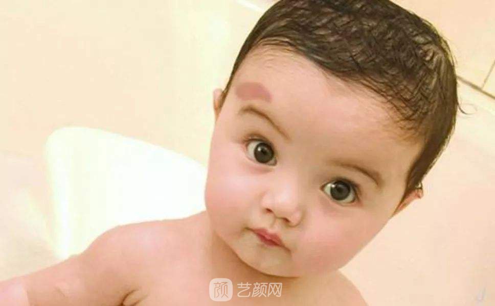 在广州去咖啡斑需要多少钱?