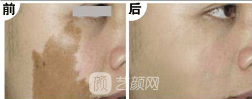 在广州去咖啡斑需要多少钱?