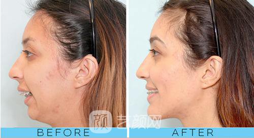 骨性龅牙怎么矫正比较好?