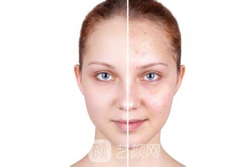 果酸换肤有果吗?果酸换肤果好吗?