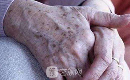 手上老年斑怎么去掉?