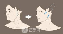 长春拉皮祛皱价格一般多少钱?