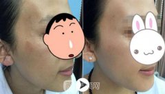 东莞光子嫩肤术价格?