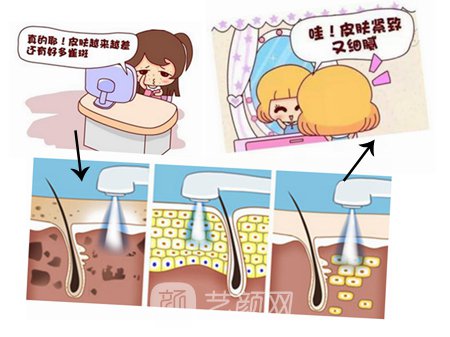 光子嫩肤会反弹吗?