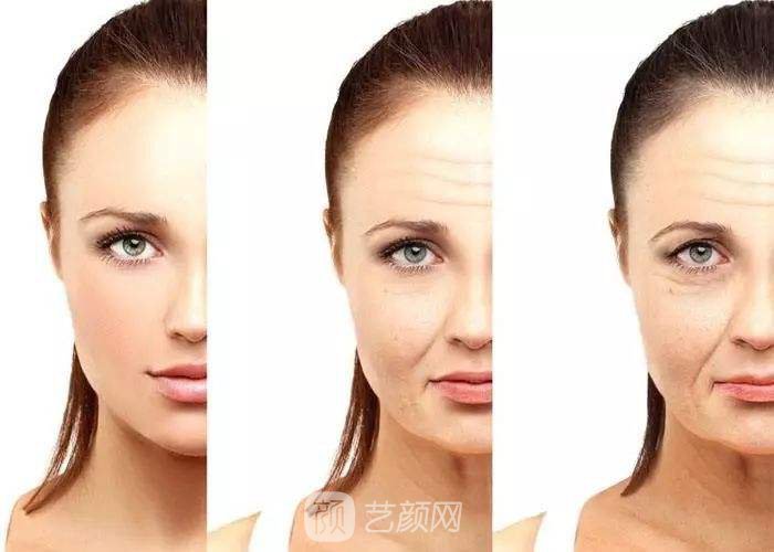 伊维兰填充除皱果好吗?伊维兰填充除皱果图~