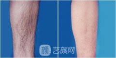 温州激光脱毛一般要多少钱？