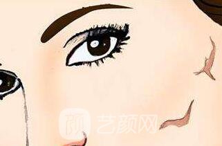 像素激光祛痘疤果好吗?像素激光祛痘疤果图?