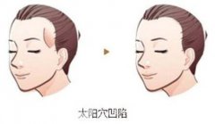 自体脂肪填充太阳穴多少钱?
