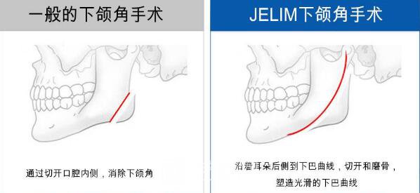 磨骨瘦脸有风险吗？磨骨瘦脸风险大吗？