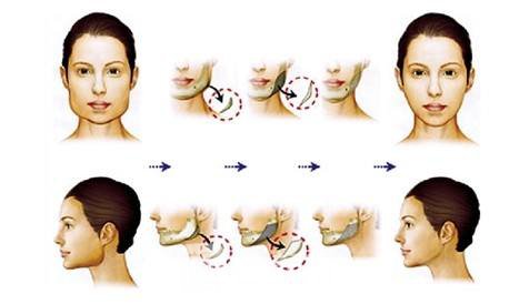 磨骨瘦脸有风险吗？磨骨瘦脸风险大吗？