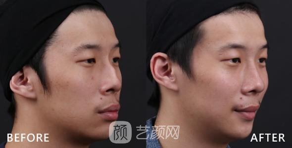 武汉驼峰鼻矫正费用大概多少?