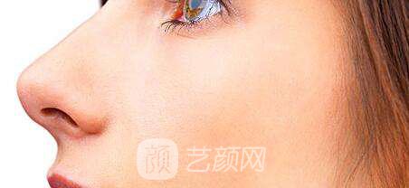 北京鼻尖整形修复多少钱