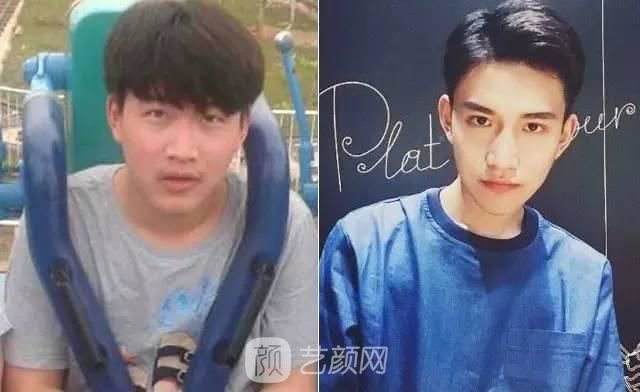 手术去法令纹果是*的吗？