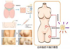 长沙自体脂肪隆胸手术价格贵不贵？