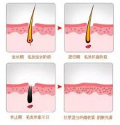 成都激光脱毛手术要多少钱，影响价格的因素有哪些？