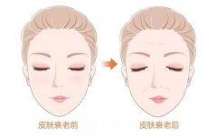 徐州拉皮除皱需要多少钱