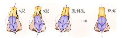 北京歪鼻矫正术价格大概多少