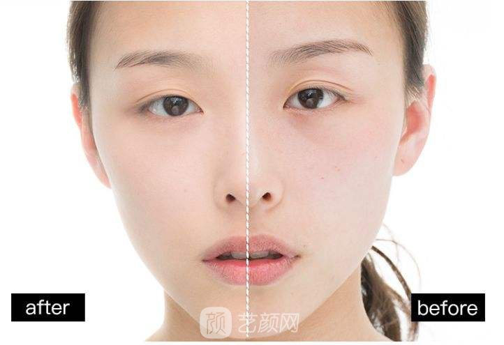 e光祛斑有副作用吗？