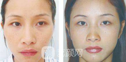 苏州丰太阳穴多少钱?