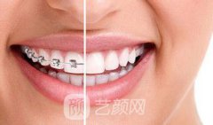 上海牙齿矫正费用