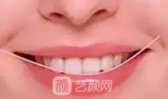 隐形矫正牙齿多少钱