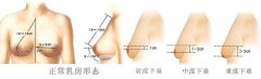 胸部下垂需要矫正嘛，价格贵不贵?