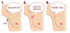 切除腋窝下副乳多少钱