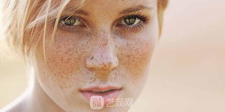 激光祛斑会反弹吗？